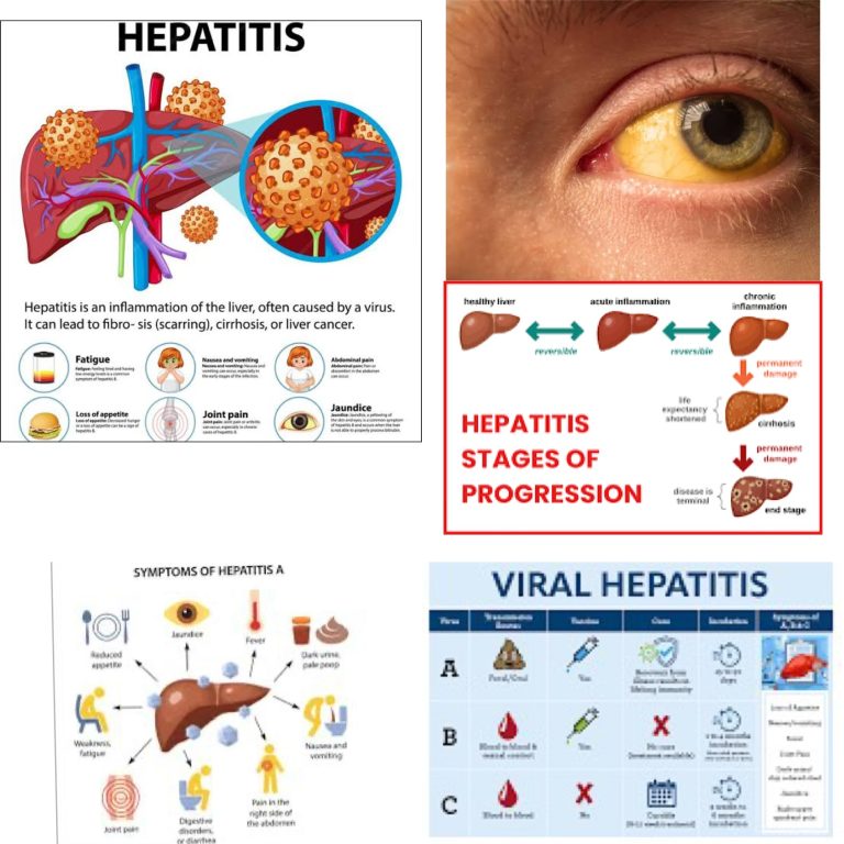 The Impact of Hepatitis on Liver Health: Understanding the Effects and Consequences